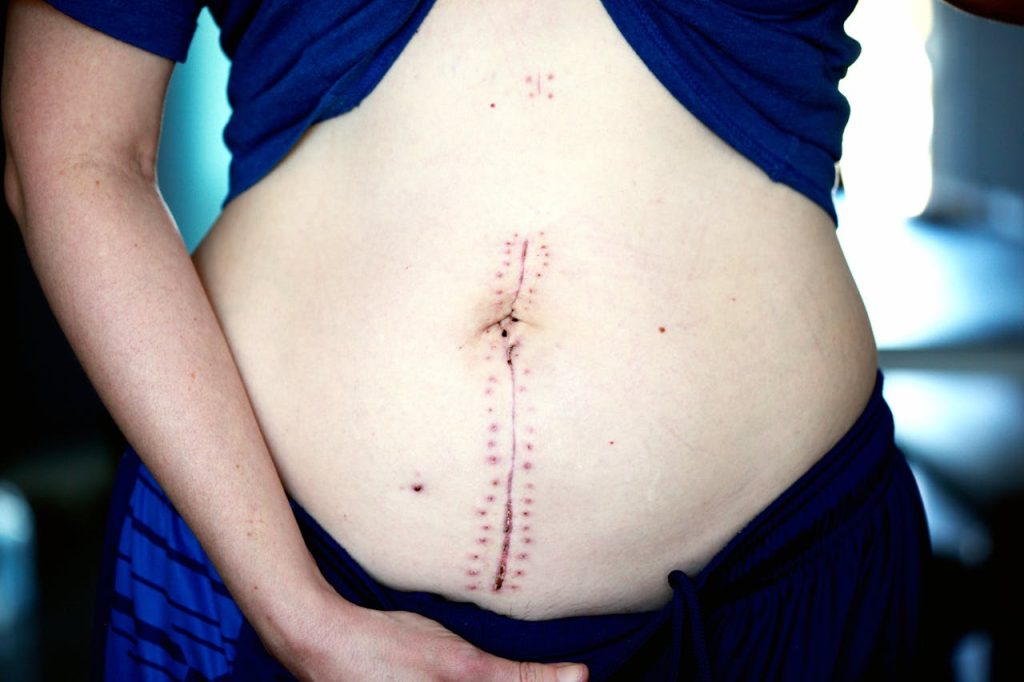 Close-up image showing a healing scar on a womans abdomen post-surgery.